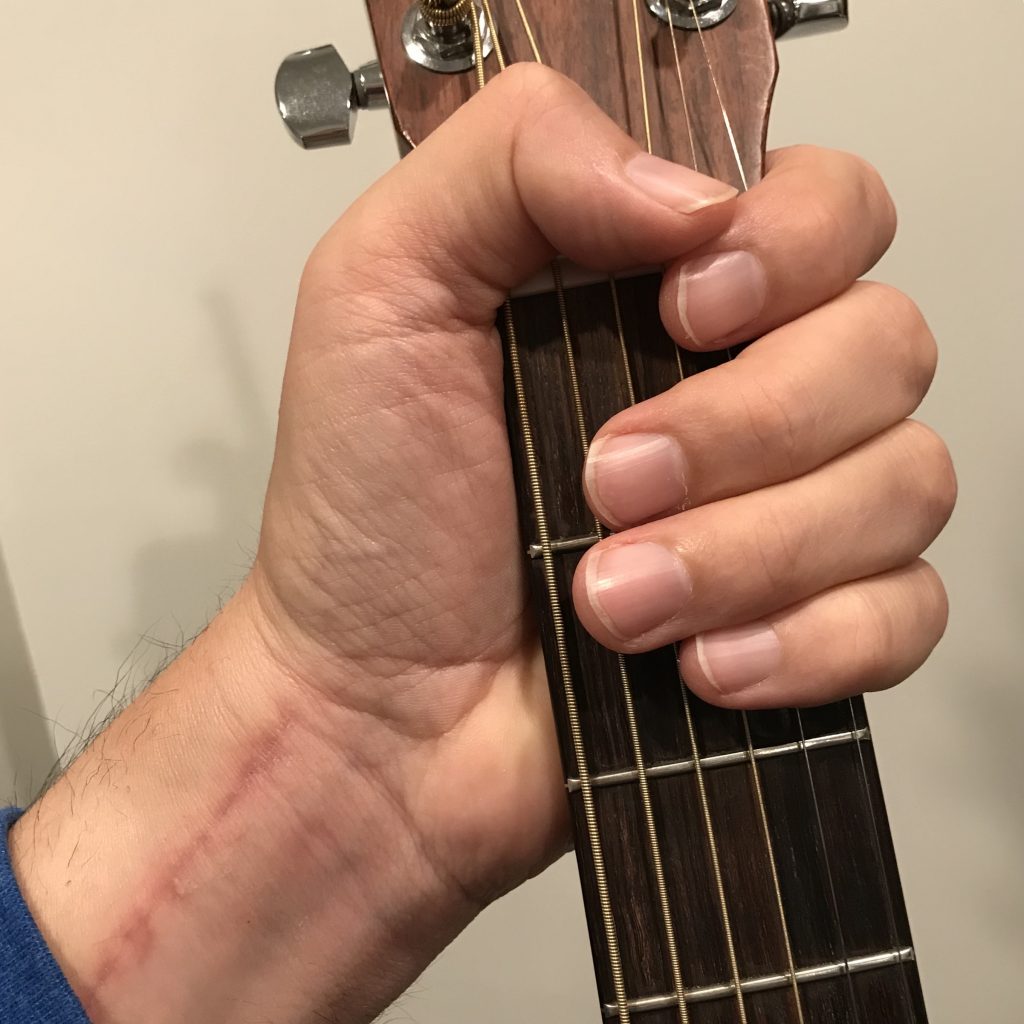 Guitar and colles fracture